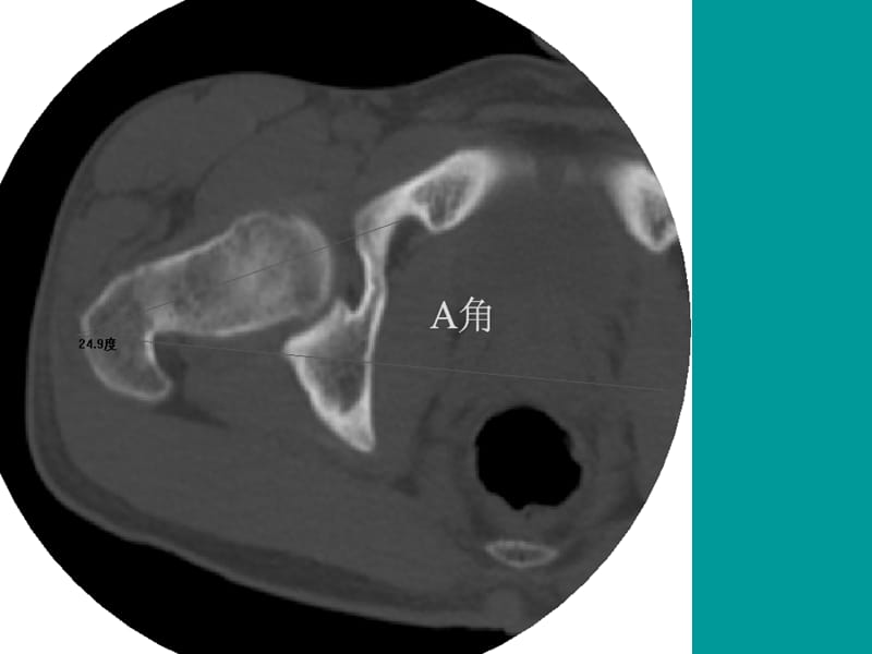 股骨颈前倾角的测量课件PPT12_第2页
