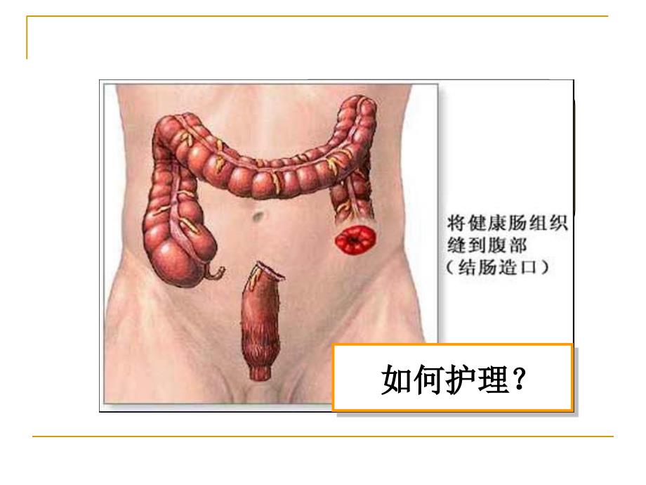 造口病人的护理PPT课件_第4页