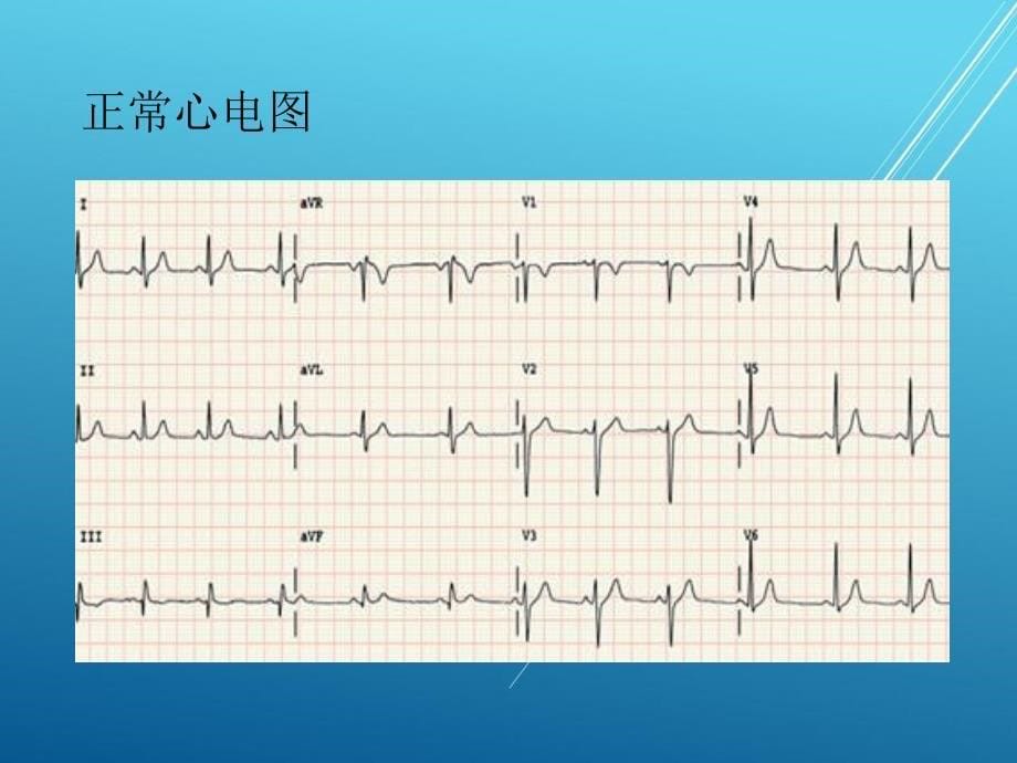 执业医师技能考试—心电图——【医学精品资源】_第5页