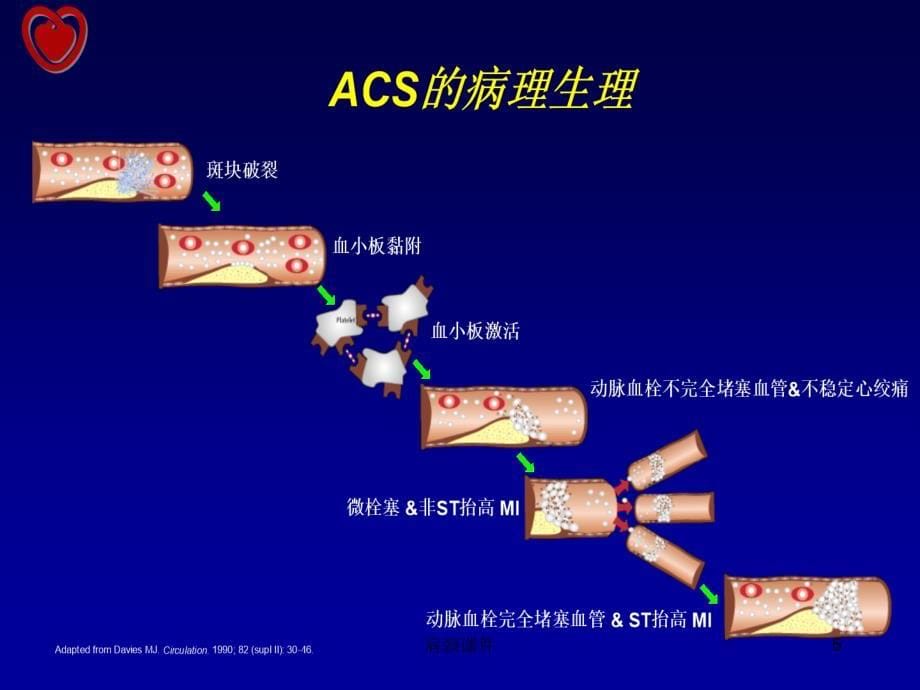 急性胸痛的护理（特选课件）_第5页