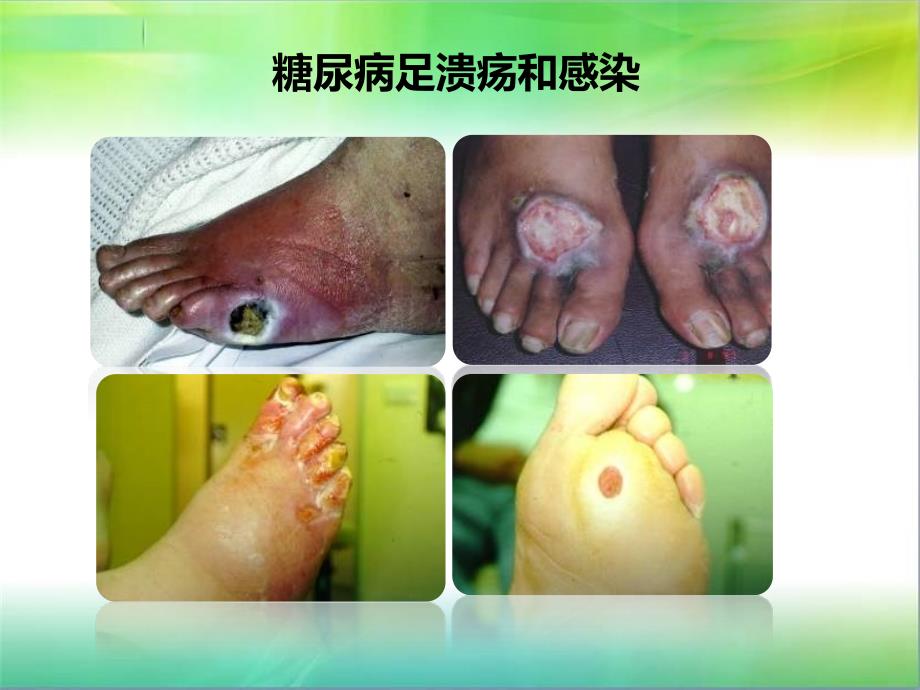 糖尿病健康教育 糖尿病足PPT课件012_第2页