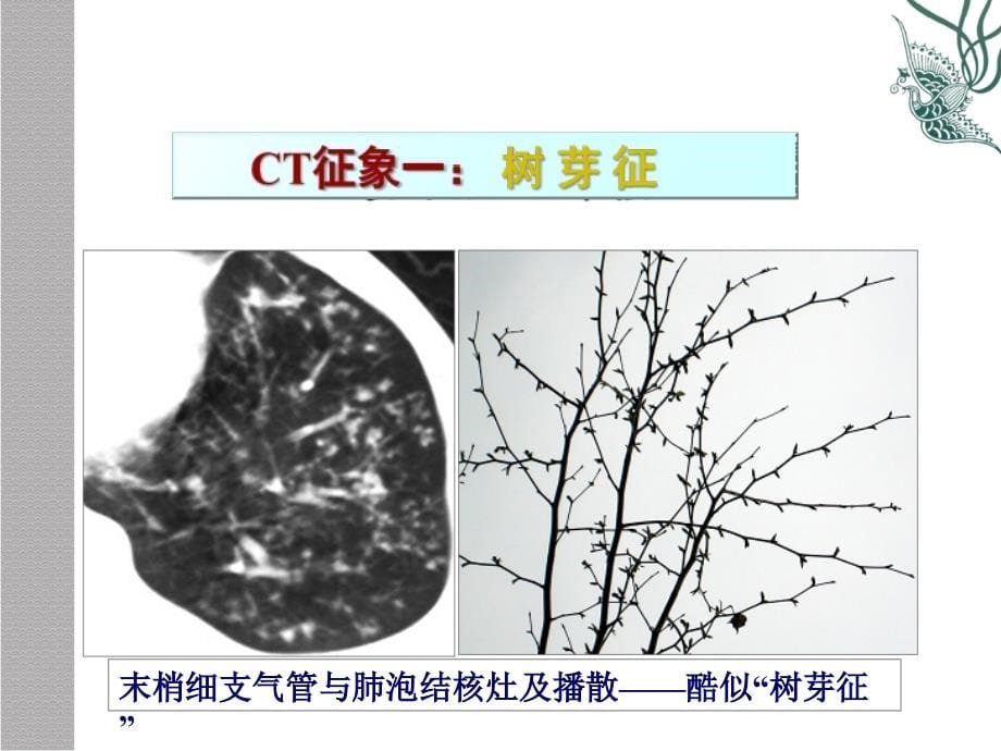 肺疾病CT征象分析象_第5页