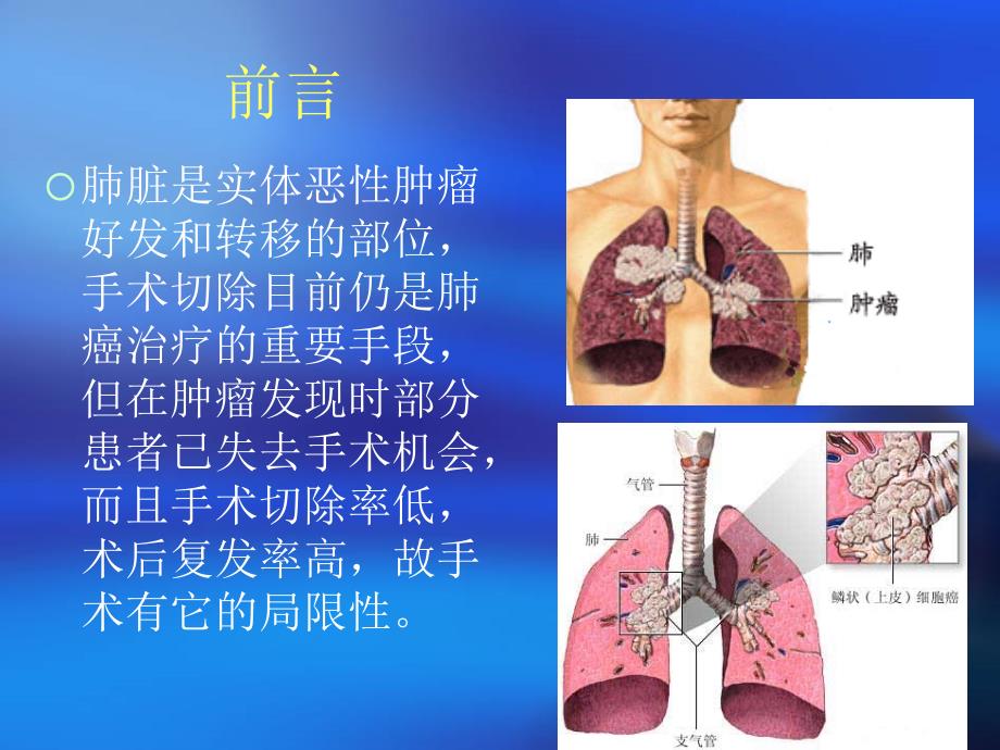 (刘育新医生)32例CT影像引导下125I粒子微创治疗肺癌分析_第3页