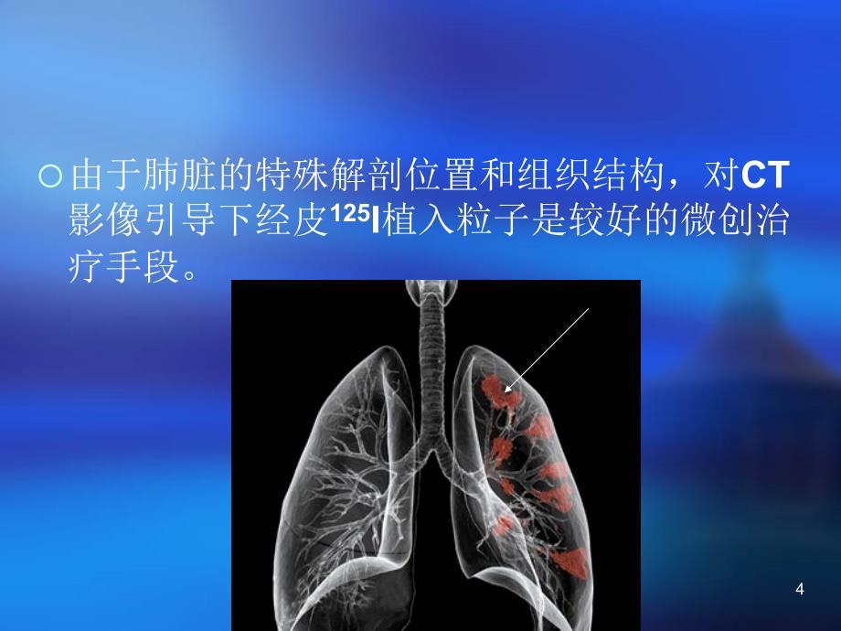 (刘育新医生)32例CT影像引导下125I粒子微创治疗肺癌分析_第4页