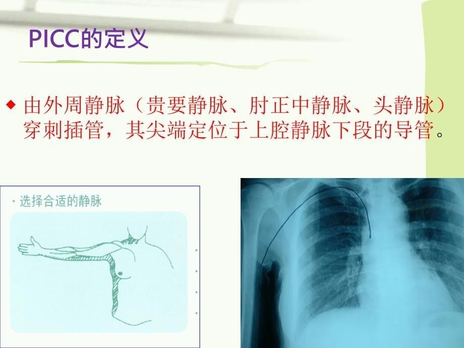 PICC临床应用与护理_第5页