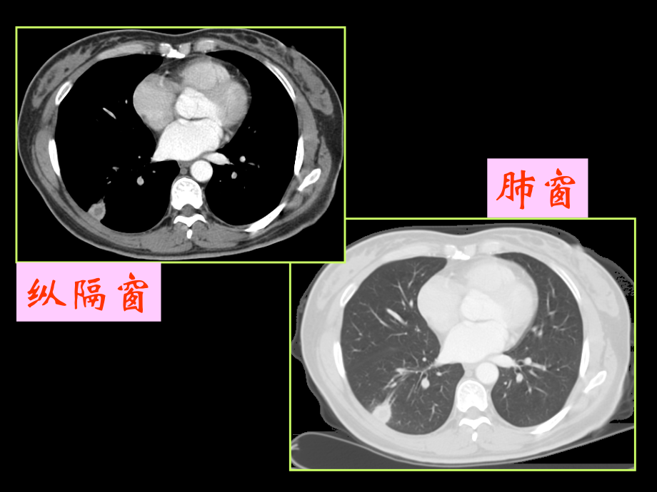 肺癌CT征象观察与分析_课件_第3页