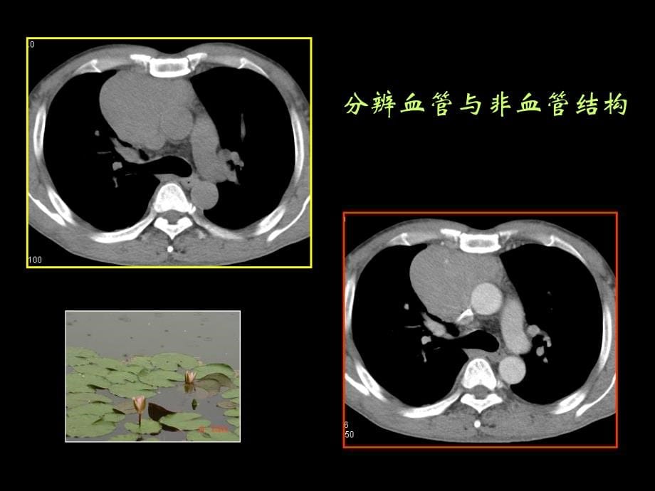 肺癌CT征象观察与分析_课件_第5页