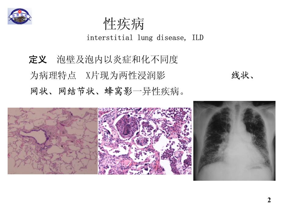 2016年天津间质性肺疾病临床诊断_第2页