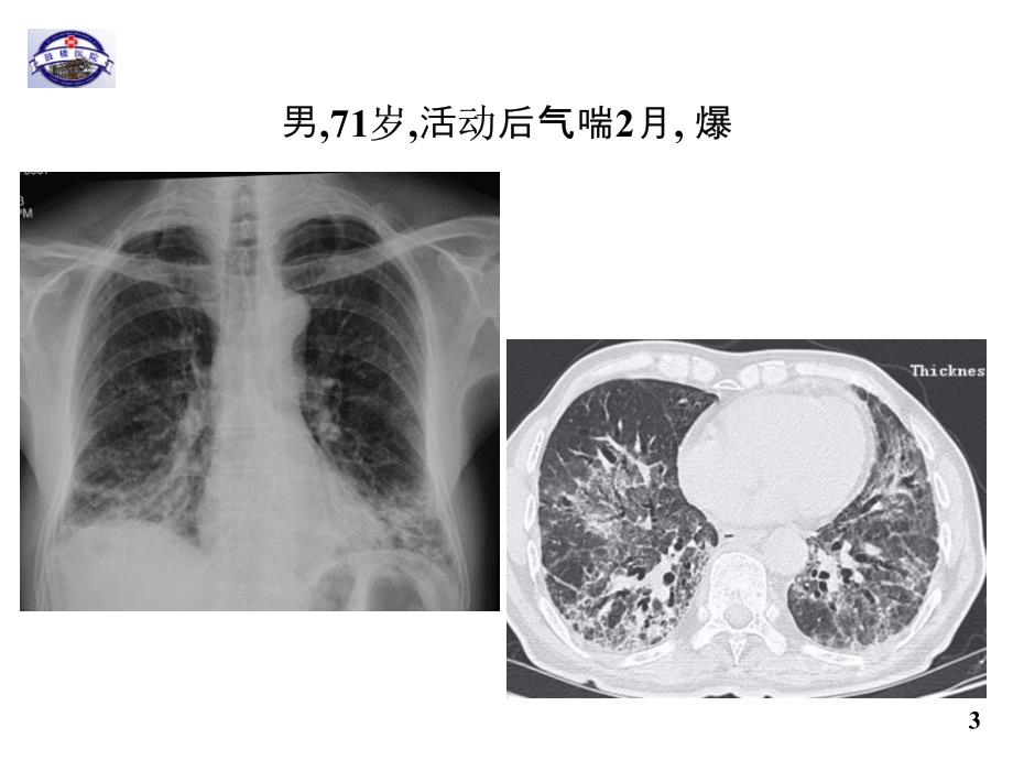 2016年天津间质性肺疾病临床诊断_第3页