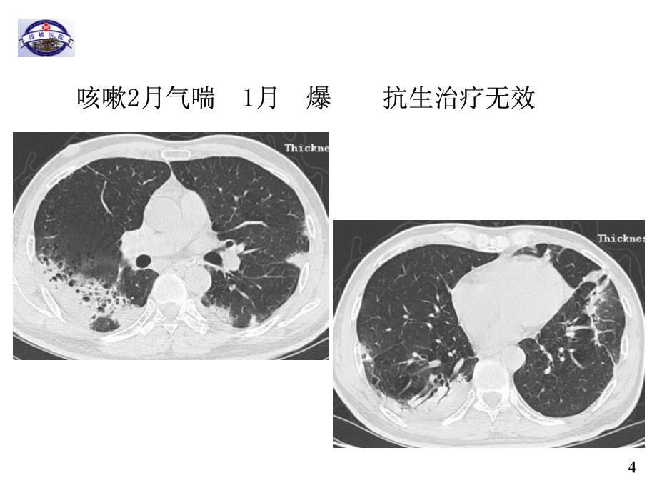 2016年天津间质性肺疾病临床诊断_第4页