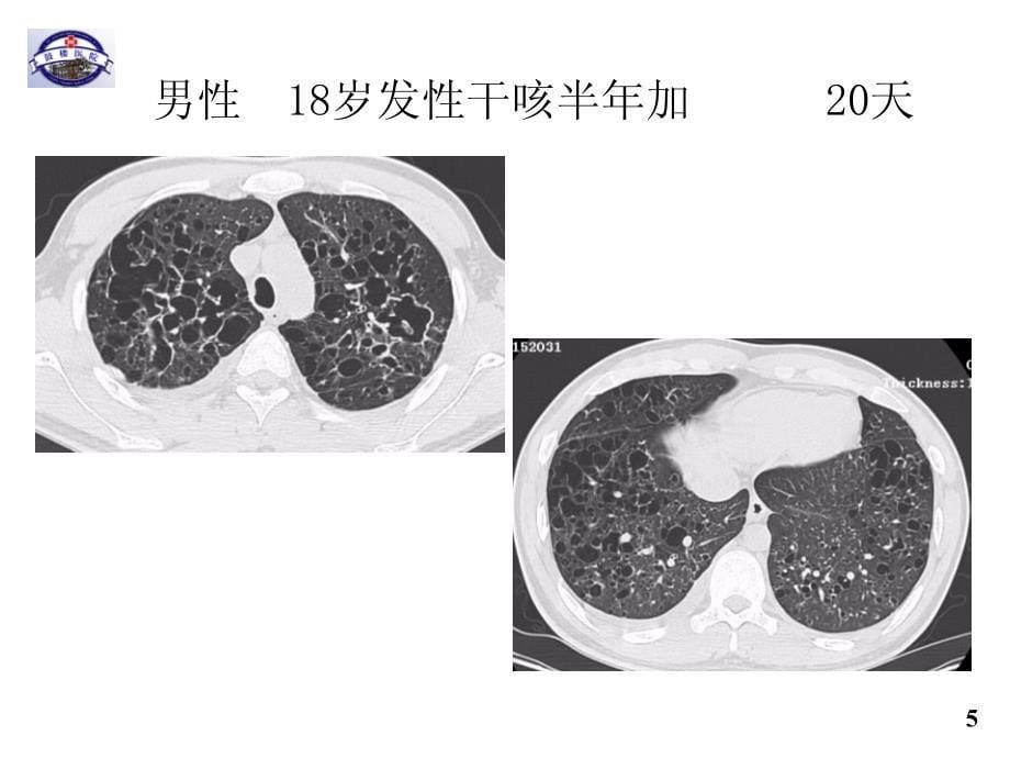 2016年天津间质性肺疾病临床诊断_第5页