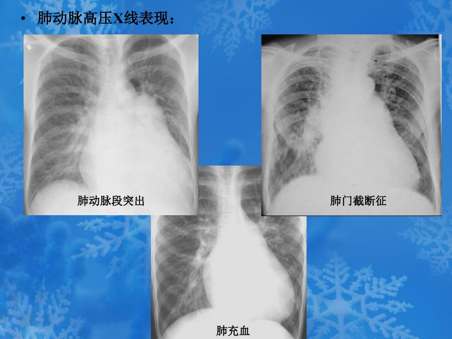 COPD影像学诊断_第4页