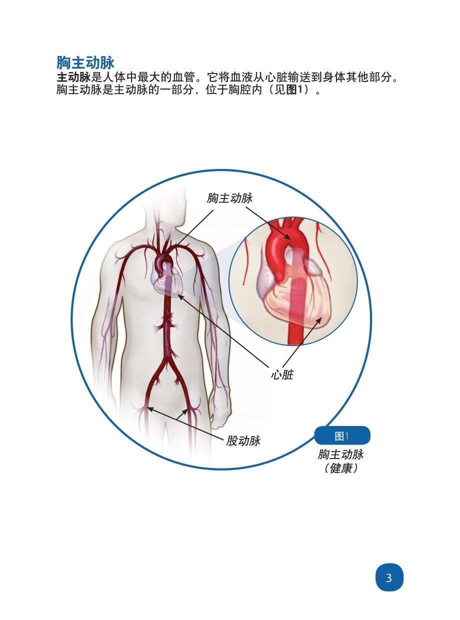 患者信息手册胸主动脉覆膜支架：胸主动脉瘤治疗方案_第5页