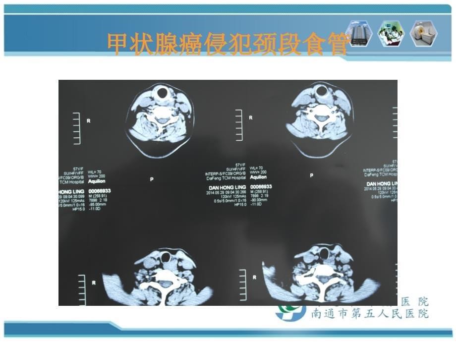 4月11日局部晚期甲状腺手术后专科护理_第5页