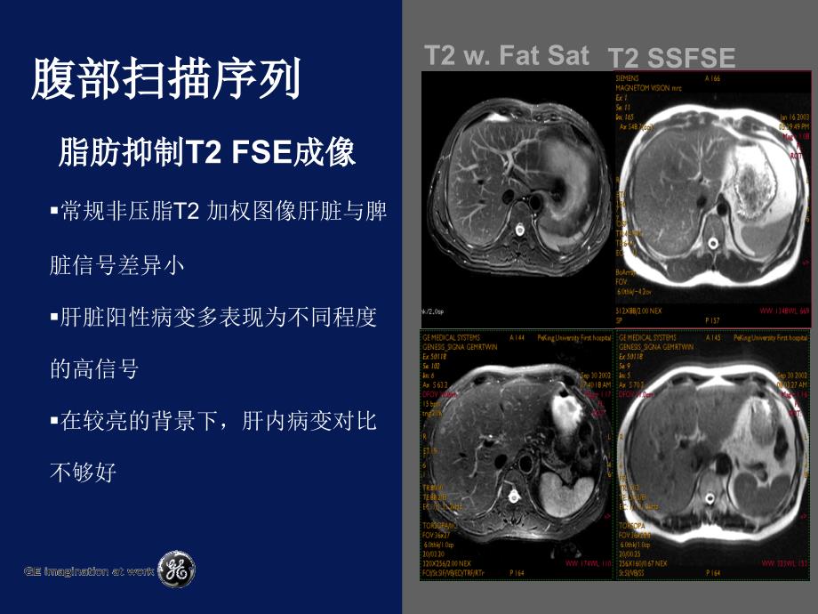 MRI在腹部疾病中应用_第4页