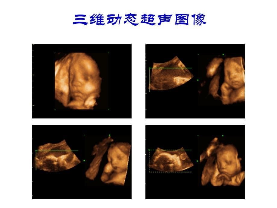 超声波超声诊断仪物理原理_第5页