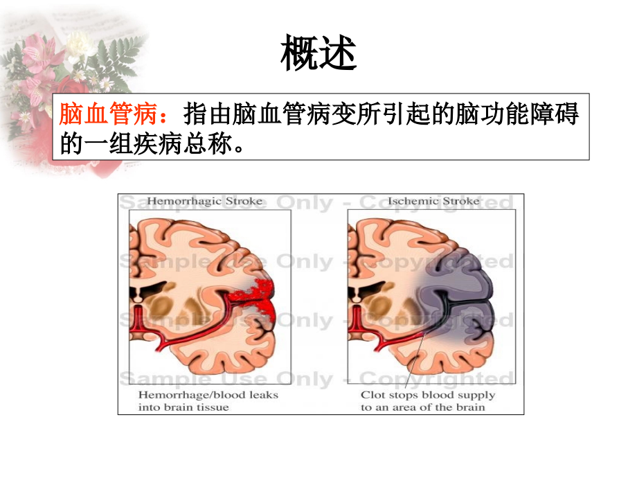 中研课件《脑血管病》_第2页