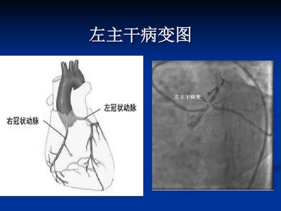 冠心病外科现状与手术_第5页