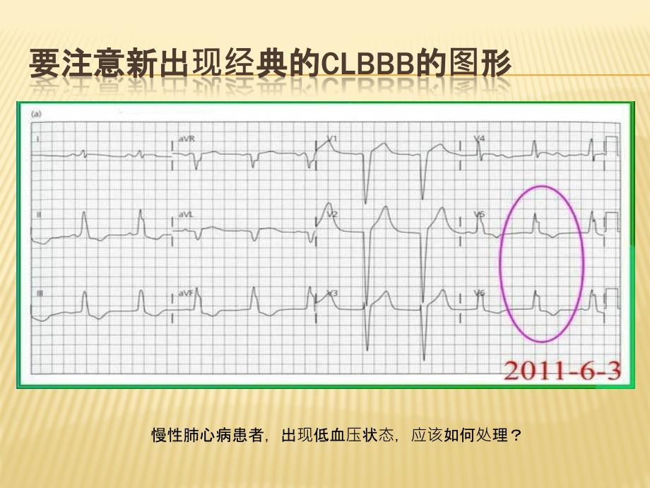 急性心梗心电图诊断陷阱_第3页