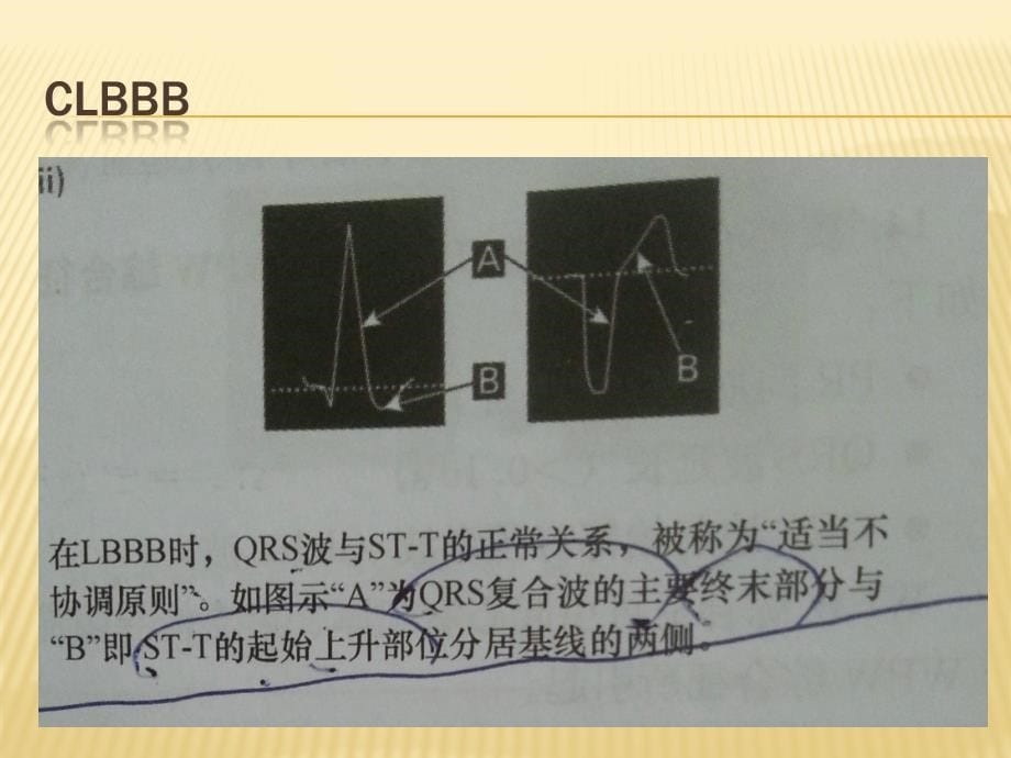 急性心梗心电图诊断陷阱_第5页