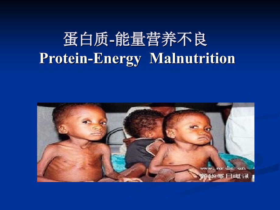 儿科蛋白质-能量营养不良PEM_第1页