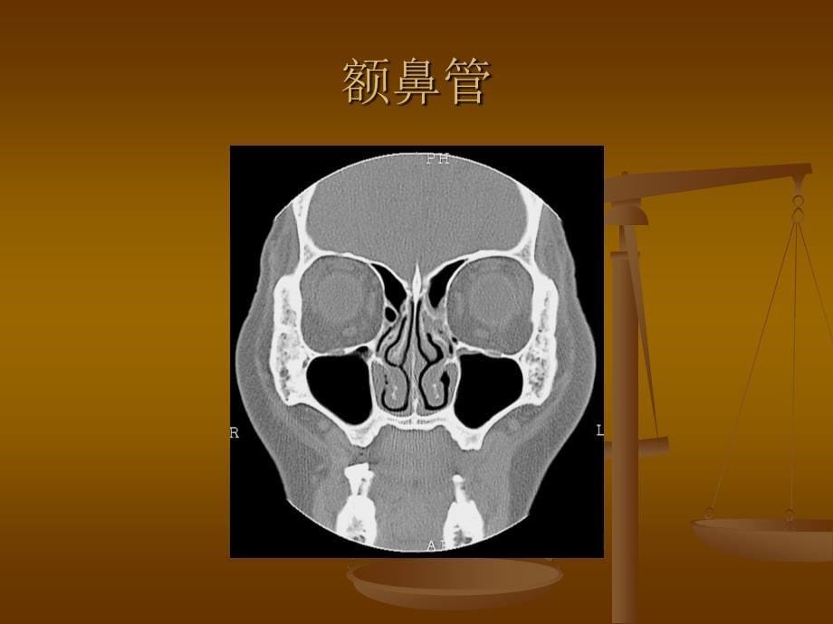 鼻窦解剖与变异CT表现_第5页