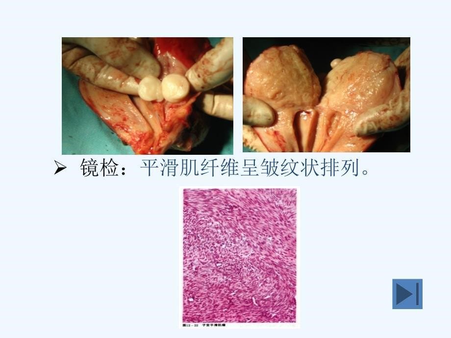 疾病查房子宫肌瘤的护理_第5页