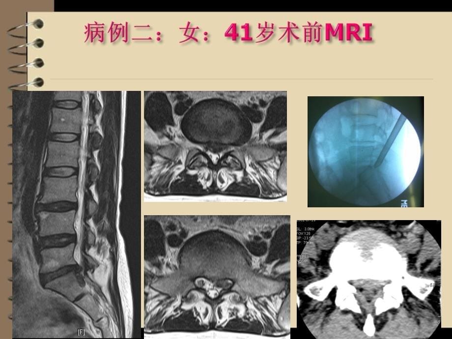 脊柱脊柱内镜技术治疗腰椎间盘突出症_第5页