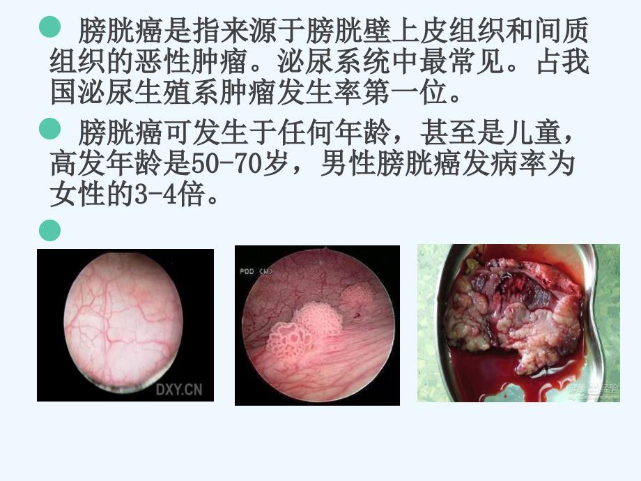 膀胱癌根治术患者护理查房_第4页