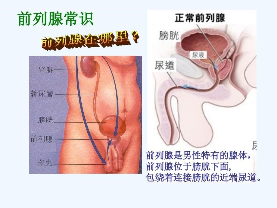 课件前列增生_第5页