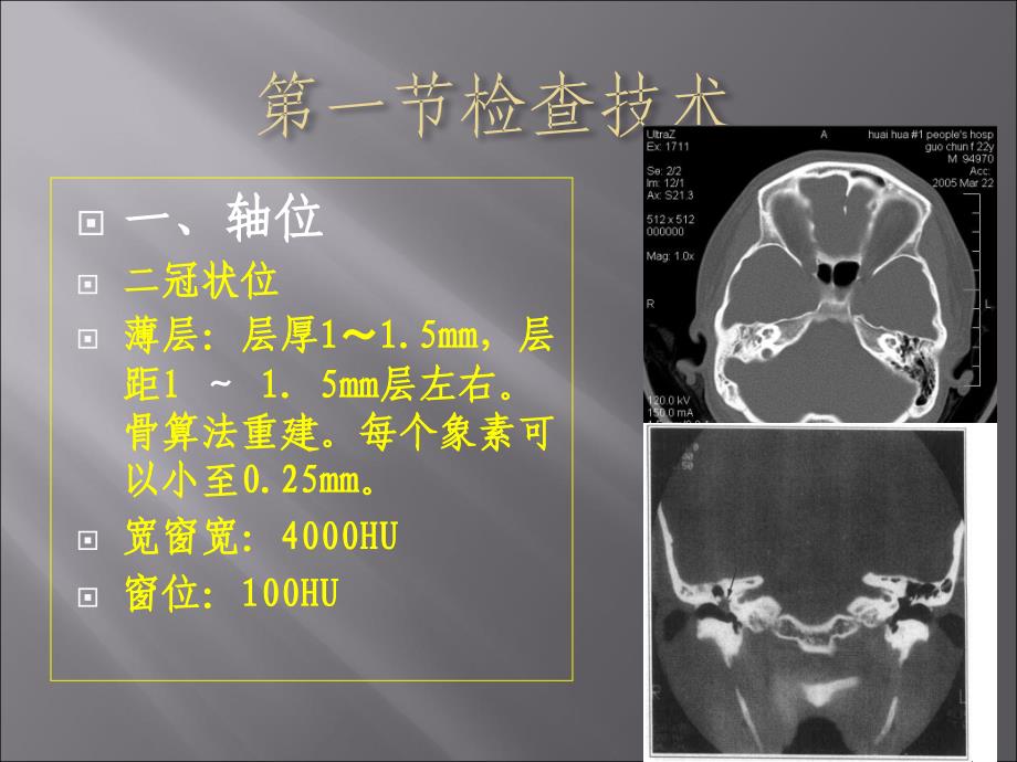 耳-颞骨病变CT诊断_第2页