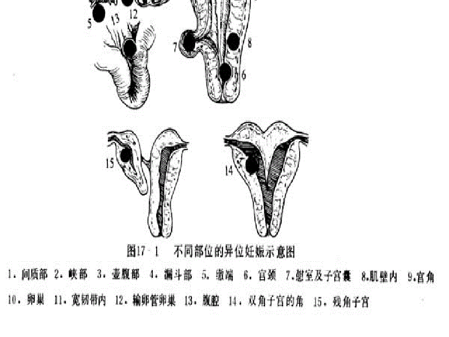 最新宫外孕ppt-219_第4页