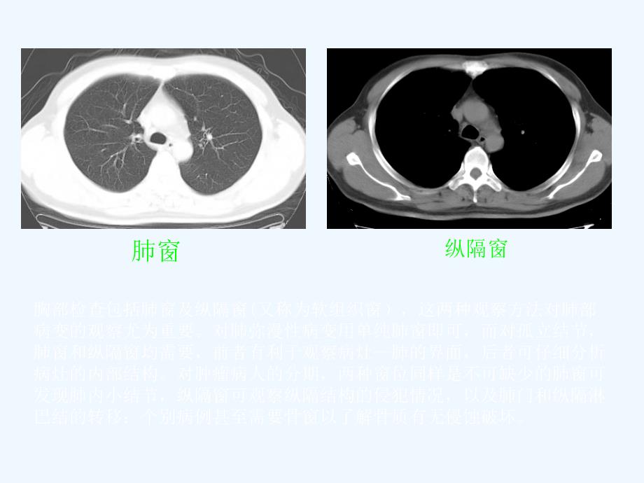 胸部CT诊断我的_第2页