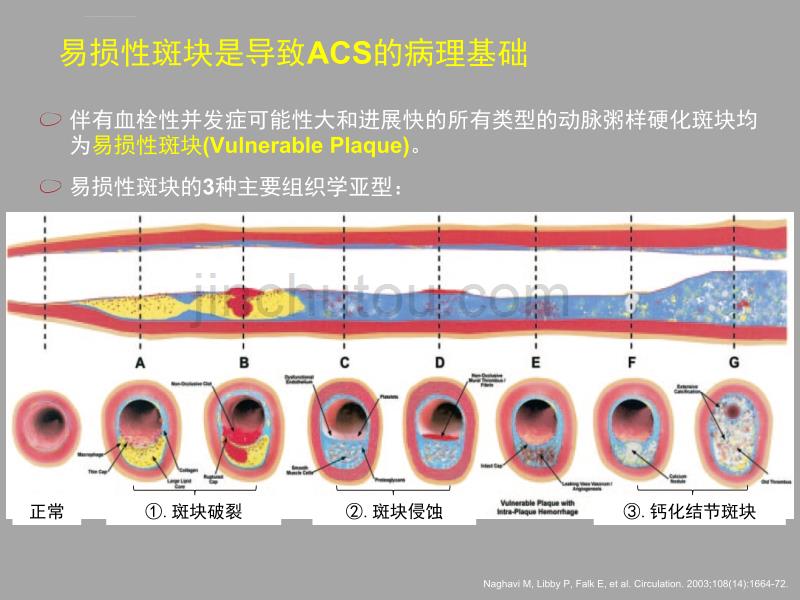 ACS疾病和长期抗血小板治疗的病理基础课件_第3页