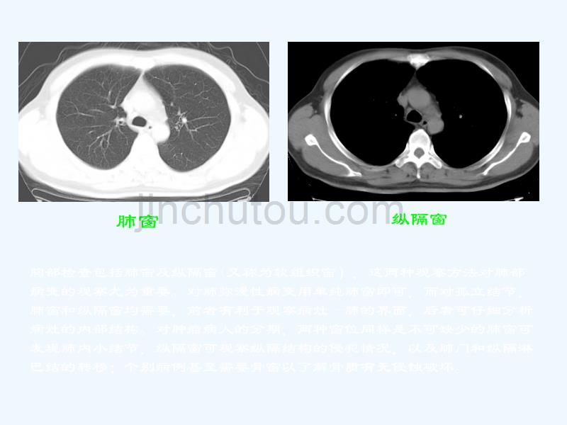 胸部CT阅读与诊断_第2页