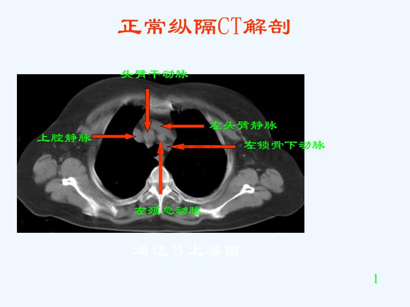 胸部CT阅读与诊断_第3页