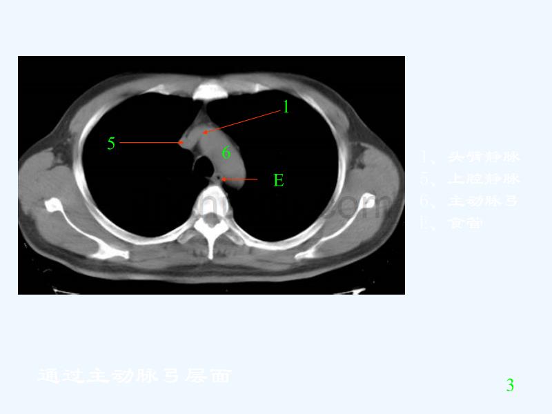 胸部CT阅读与诊断_第4页
