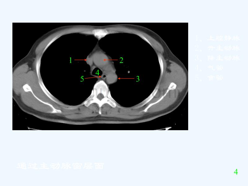 胸部CT阅读与诊断_第5页