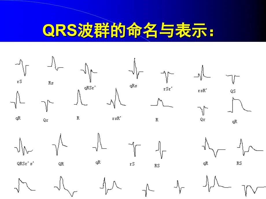 心电图学习 T波心梗_第5页