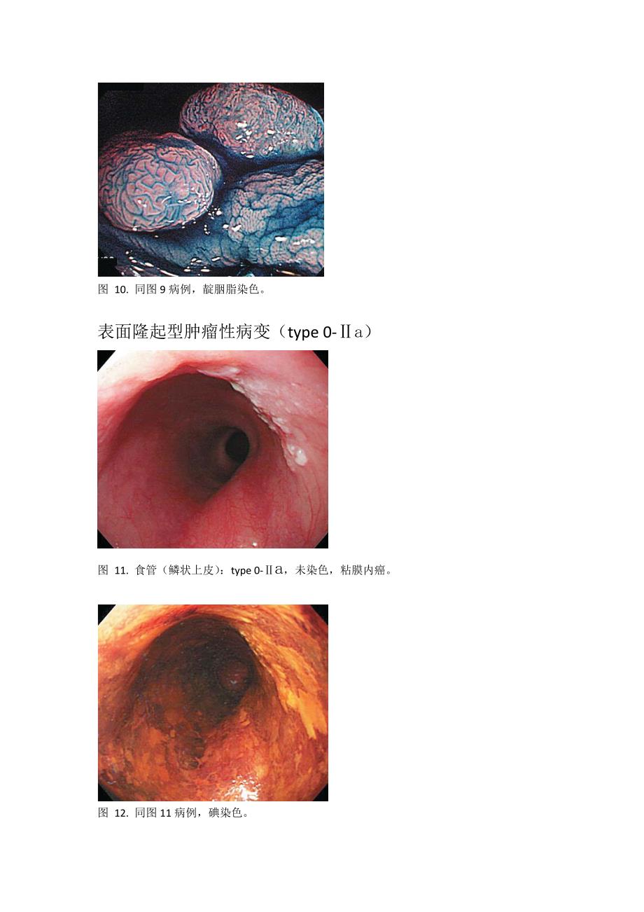 早癌的内镜下表现_第4页