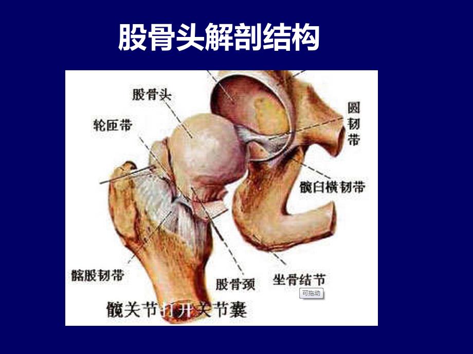 股骨头坏死简介PPT_第2页