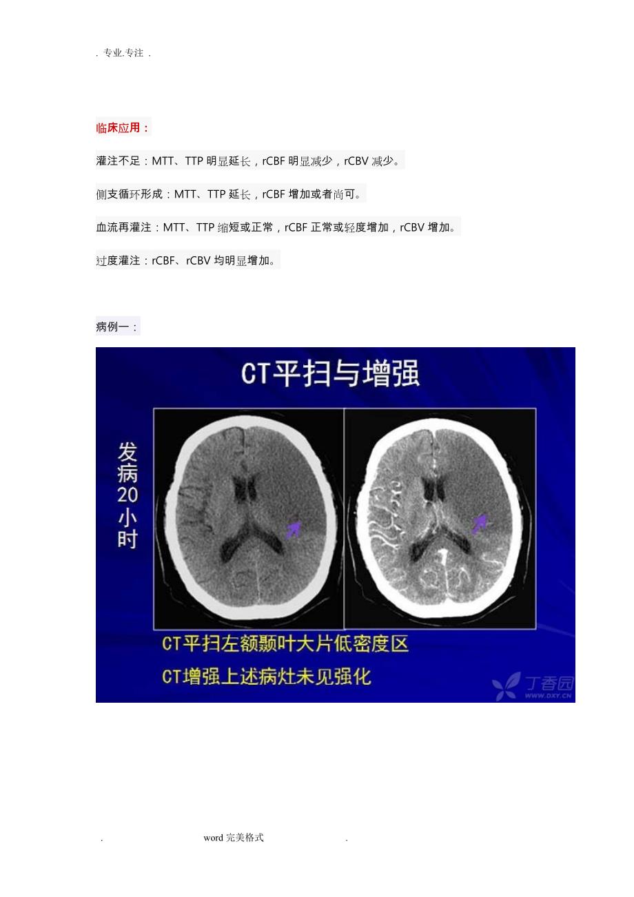 脑缺血CT灌注基础知识_第4页