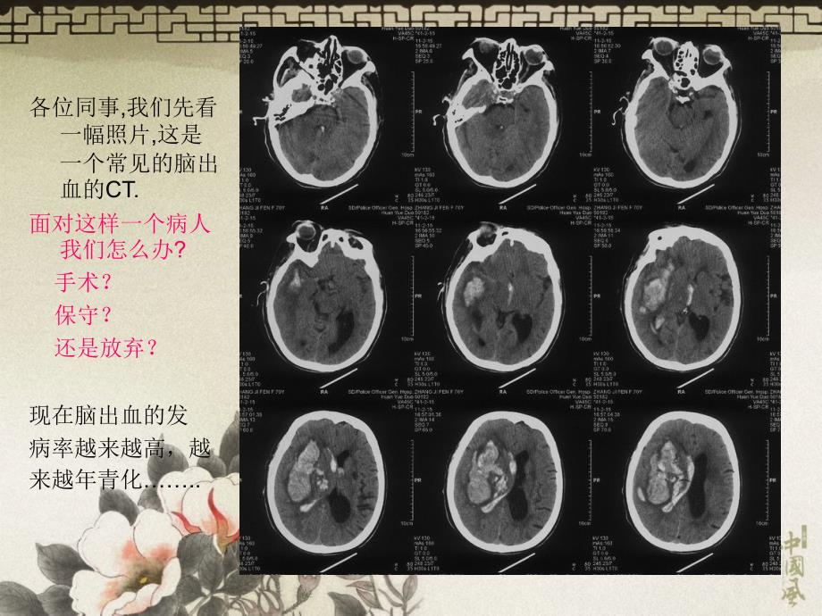 1高血压脑出血的治疗－蒋小杰_第2页