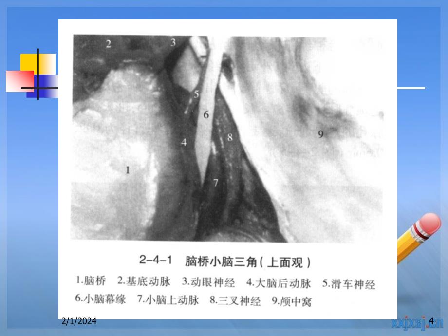 听神经鞘瘤1 (2)_第4页