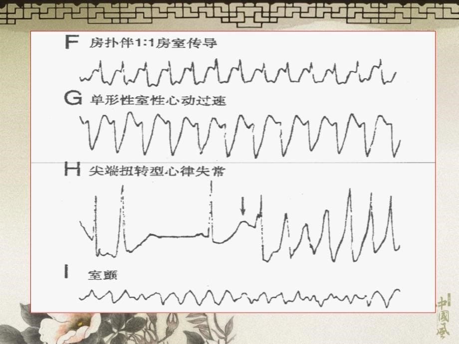 1抗心律失常药_第5页