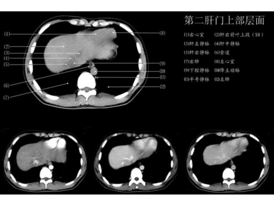 上腹部CT各个层面(精品)_第3页