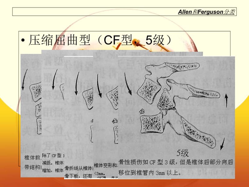 下颈椎损伤的治疗策略 (2)_第4页