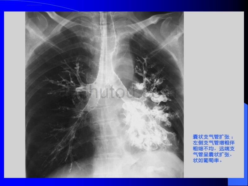 !气管和支气管疾病_第5页