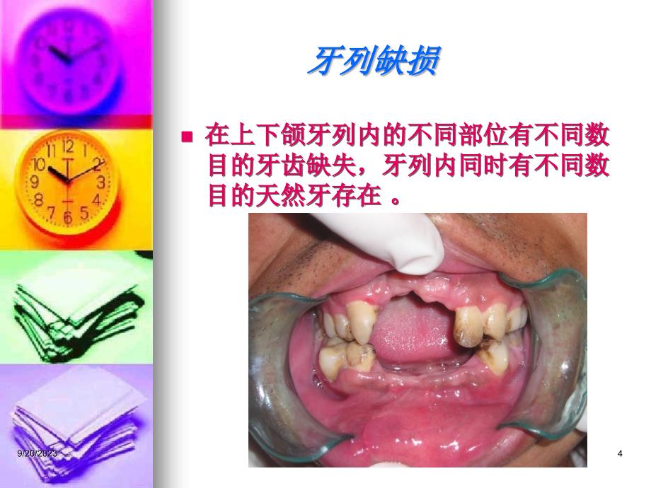 可摘局部义齿qu--RPD（98页）_第4页