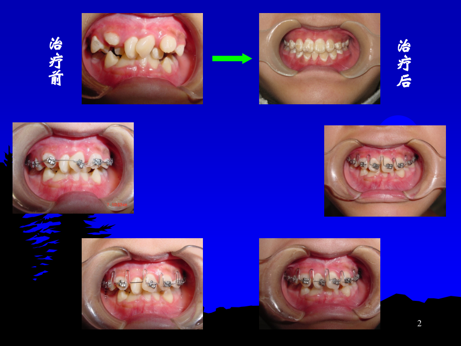 正畸学牙列拥挤ppt课件.ppt_第2页